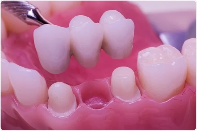 Complications for Dental bridge