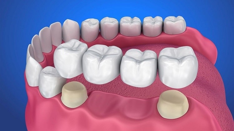 Dental bridge