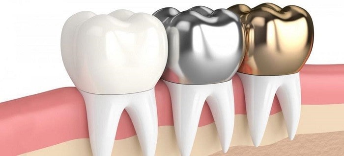 What Dental crown 