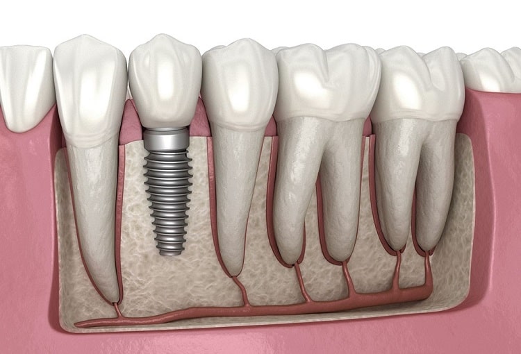 Fixture for Dental implant