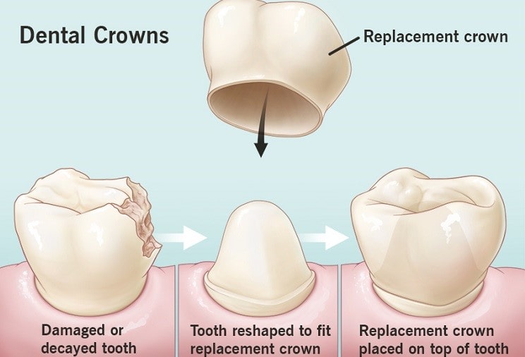 Dental crown Procedure