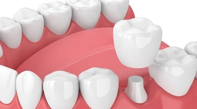 crown replacement