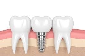 Dental Implant Lifespan