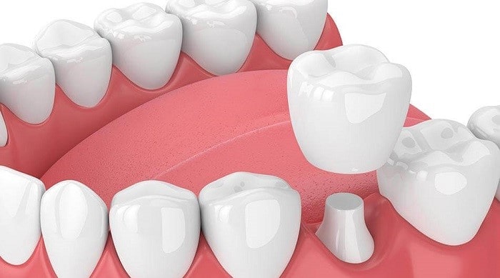 permanent Dental crown