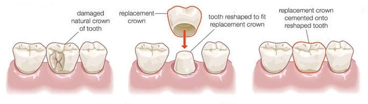 dental crown replacement procedure 