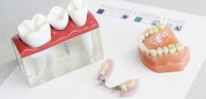 Dental Implants vs. Dentures