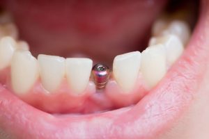 How will my dental implant be fitted-min