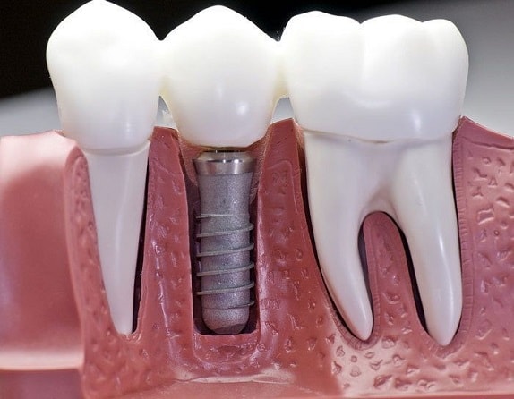 What is the procedure and aftercare of Dental implant surgery? - missionimplantcenter