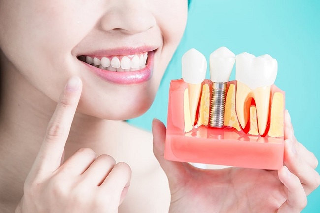 Advantages of Dental Implants 