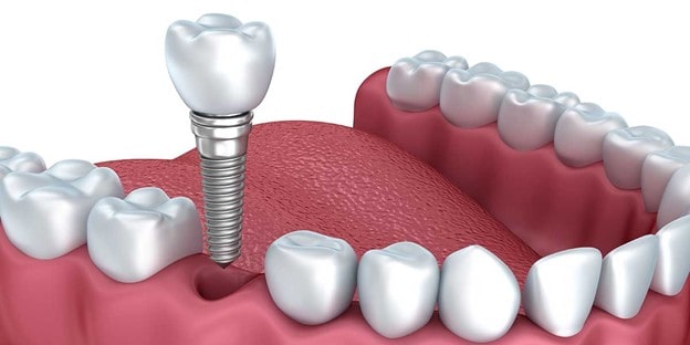 Dental implant components 