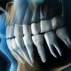 Ladera Ranch Dental Implant