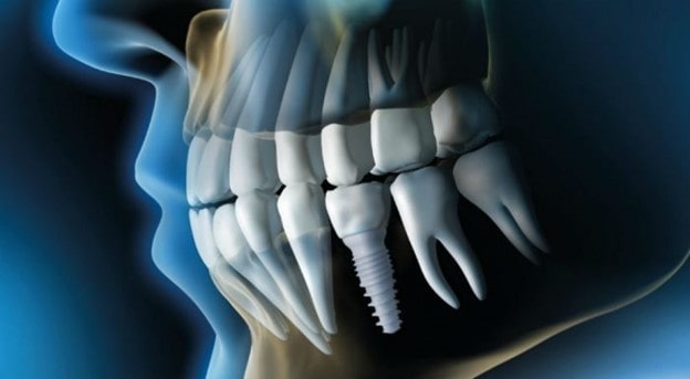 Ladera Ranch Dental Implant