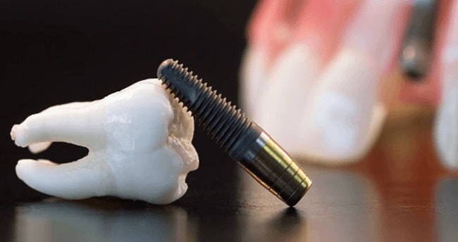 Laguna Hills Dental Implant