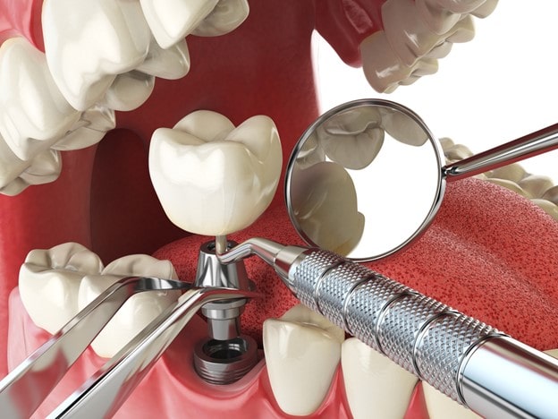 What is a Dental Implant Procedure