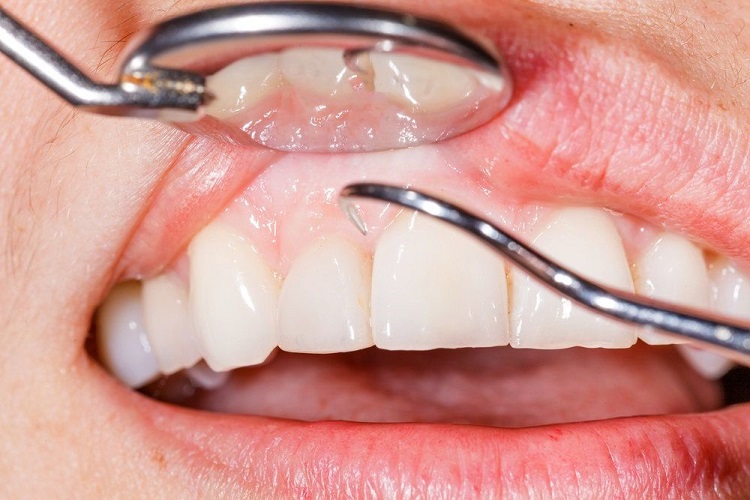 Gum contouring procedure