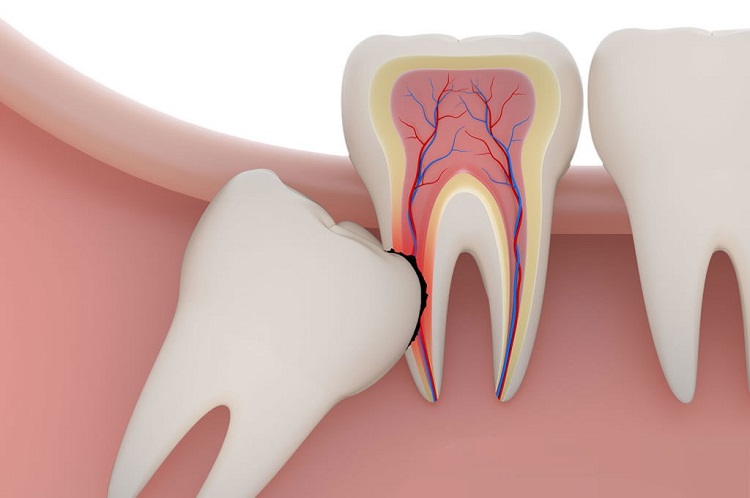 blood clot wisdom teeth bad