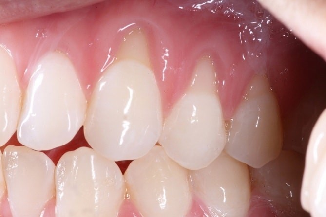 Risk Factors for Gum Recession