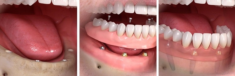 The All on 4 dental implant Procedure