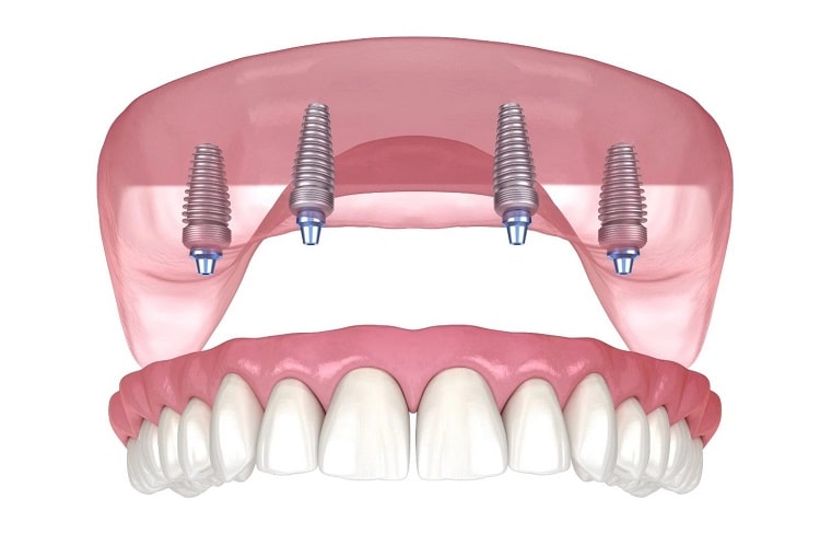 What Are the Side Effects of All on 4 implants