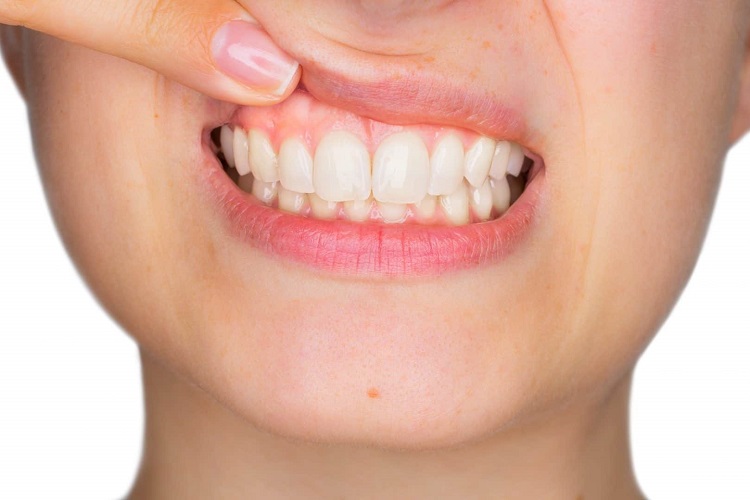 What Causes Uneven Gums