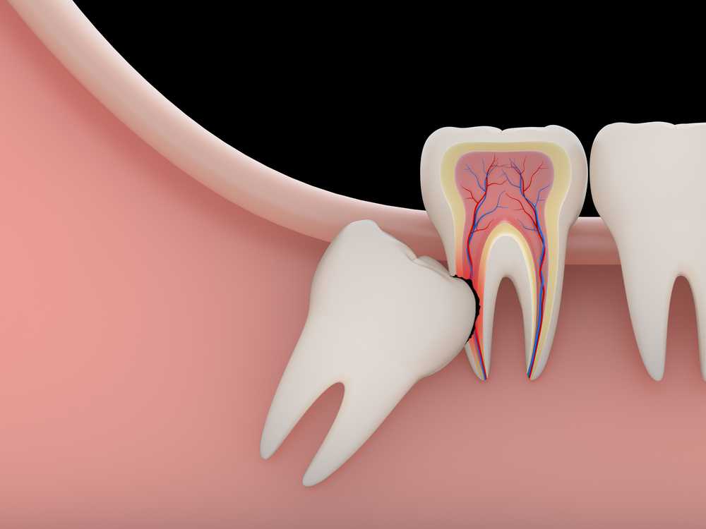 Hidden wisdom teeth