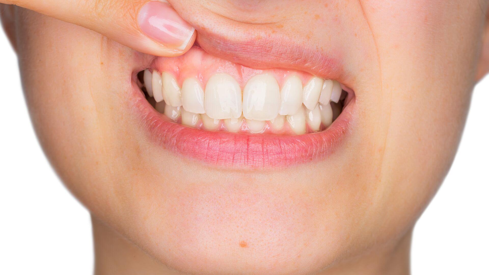 Infection after gum surgery