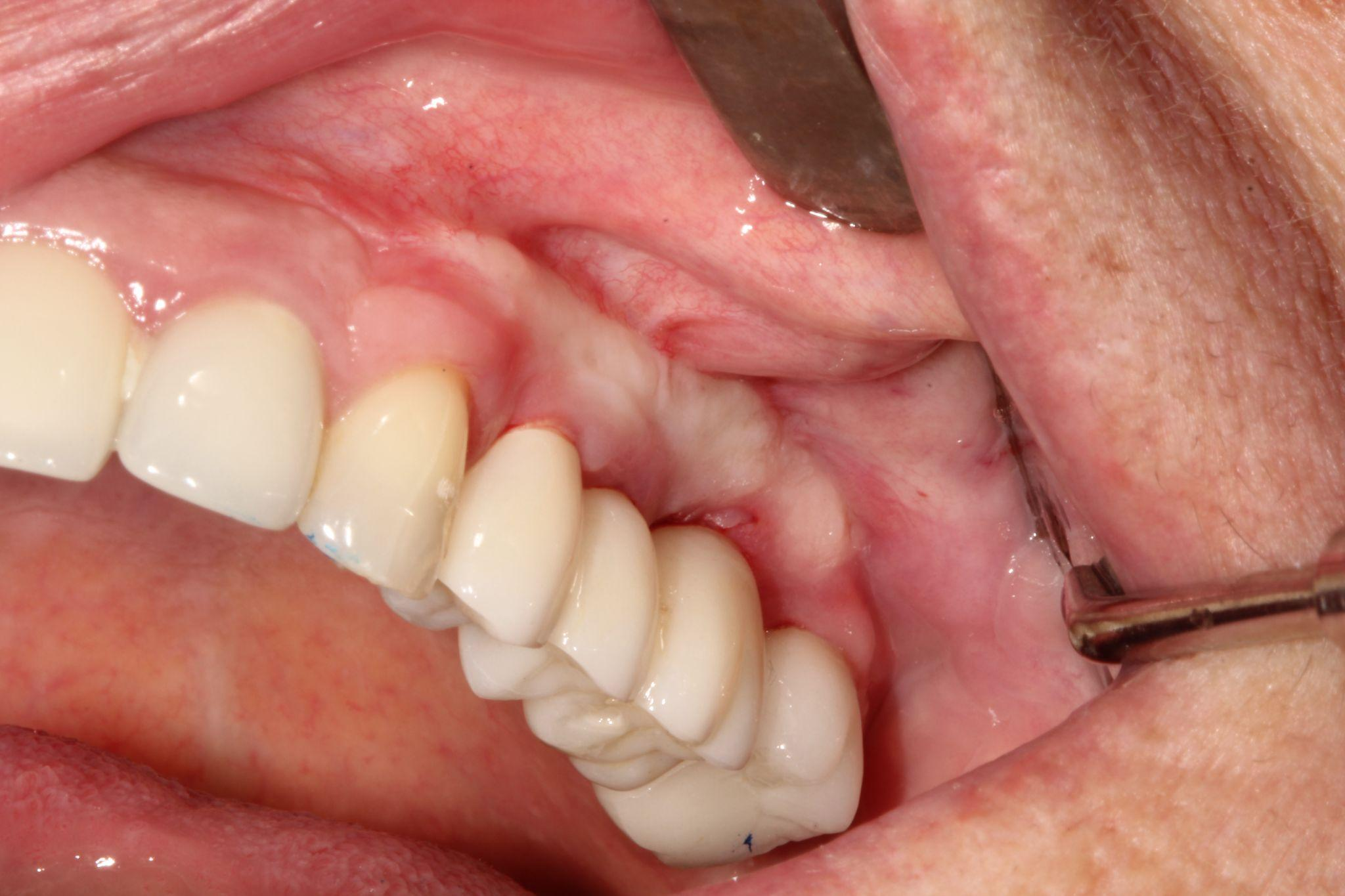 A dental implant after being added to a person's upper jaw