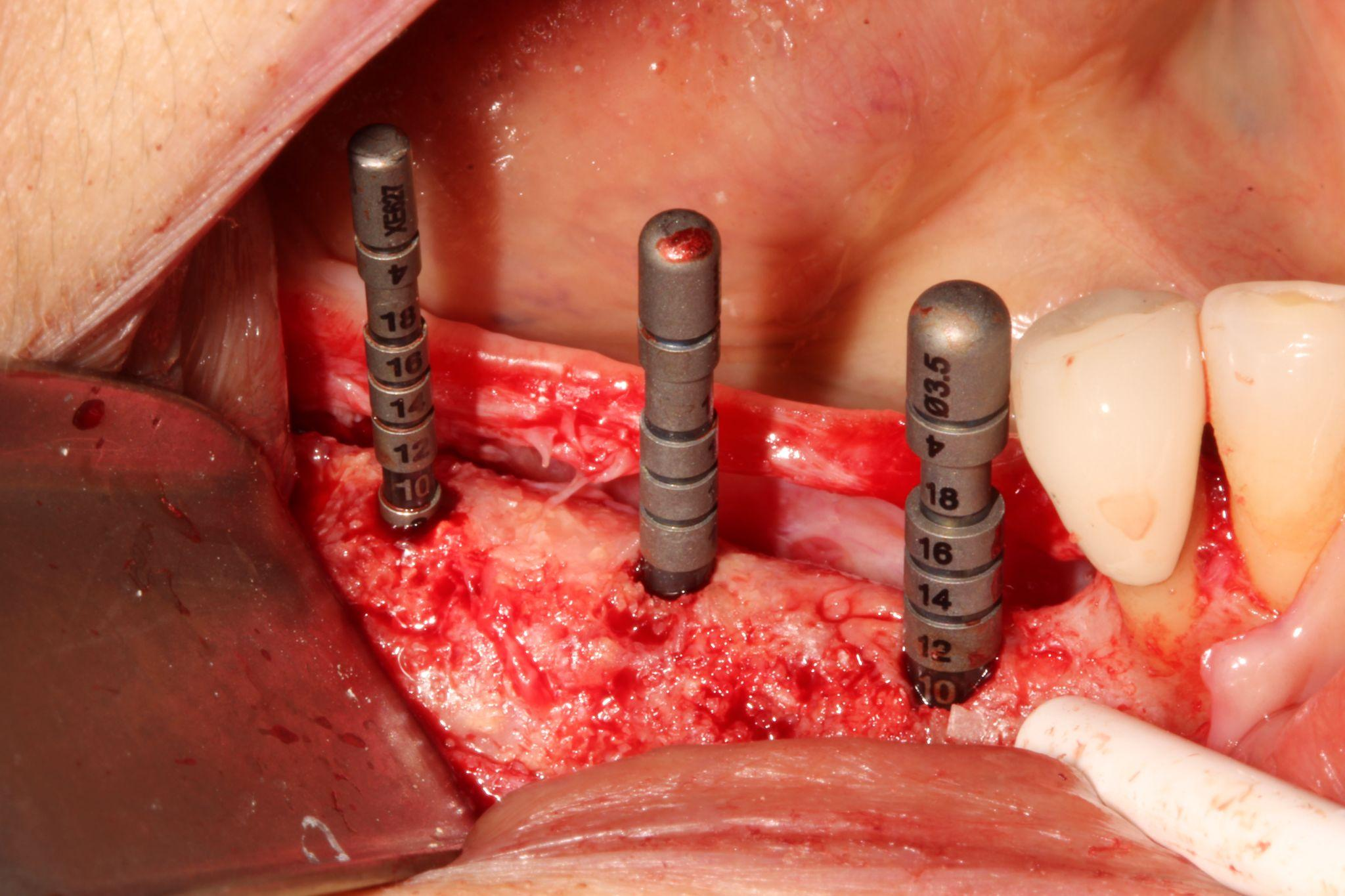 Dental implant being prepared for installation