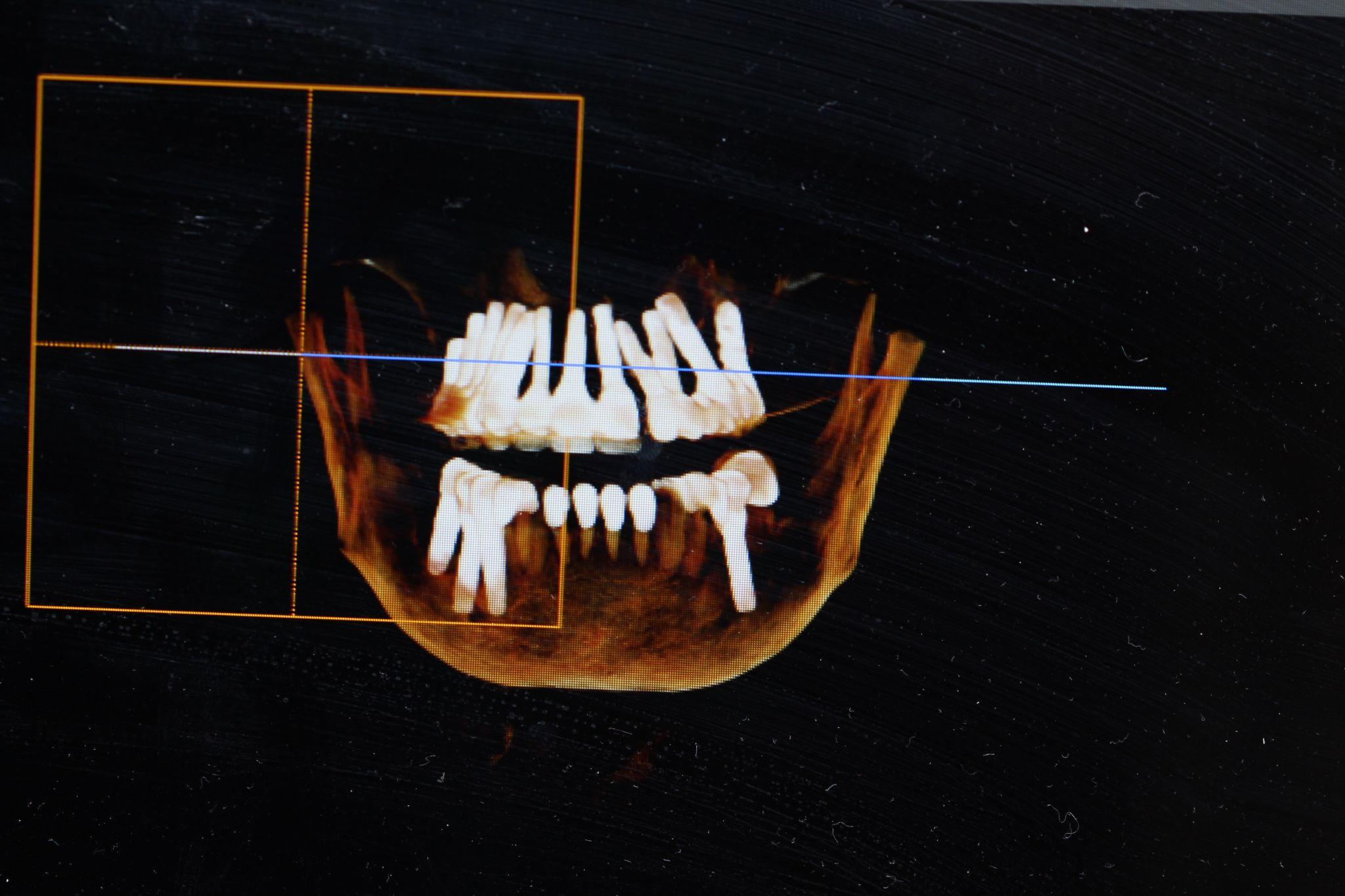 Front-facing dental x-ray of a patient