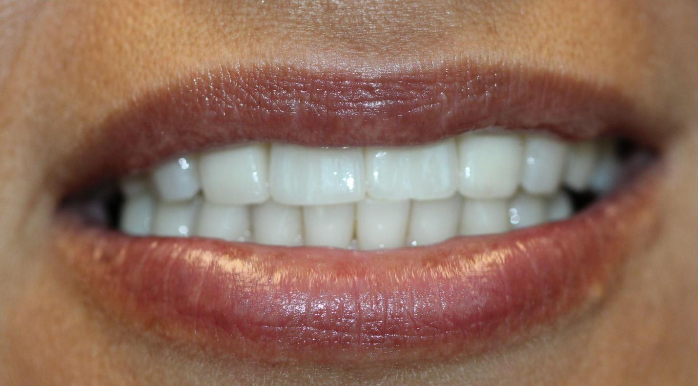 A patient's smile after undergoing a dental procedure