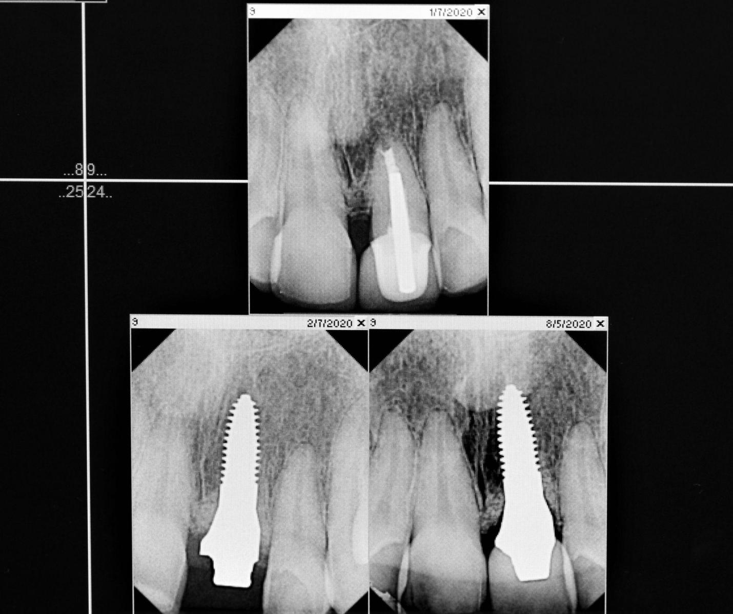 An x-ray of a patient's dental implant