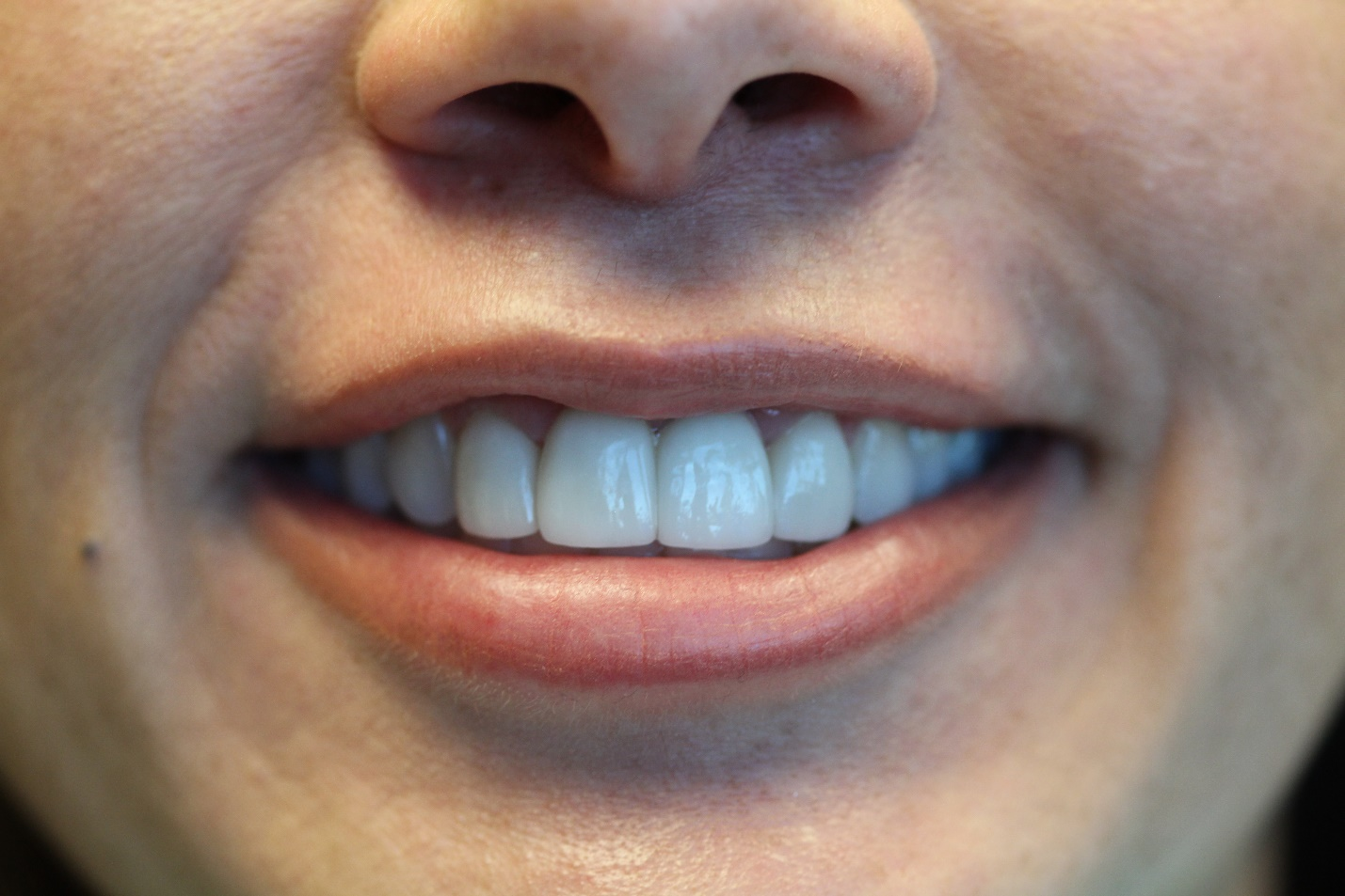 Closeup of a patient’s white teeth