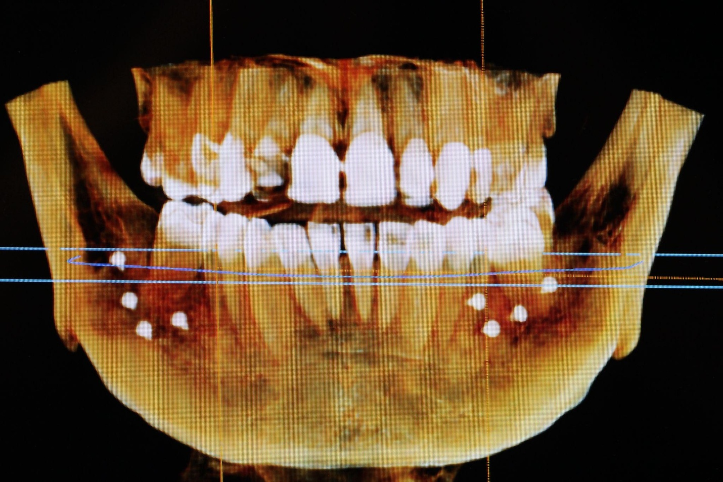 An x-ray of a patient’s mouth