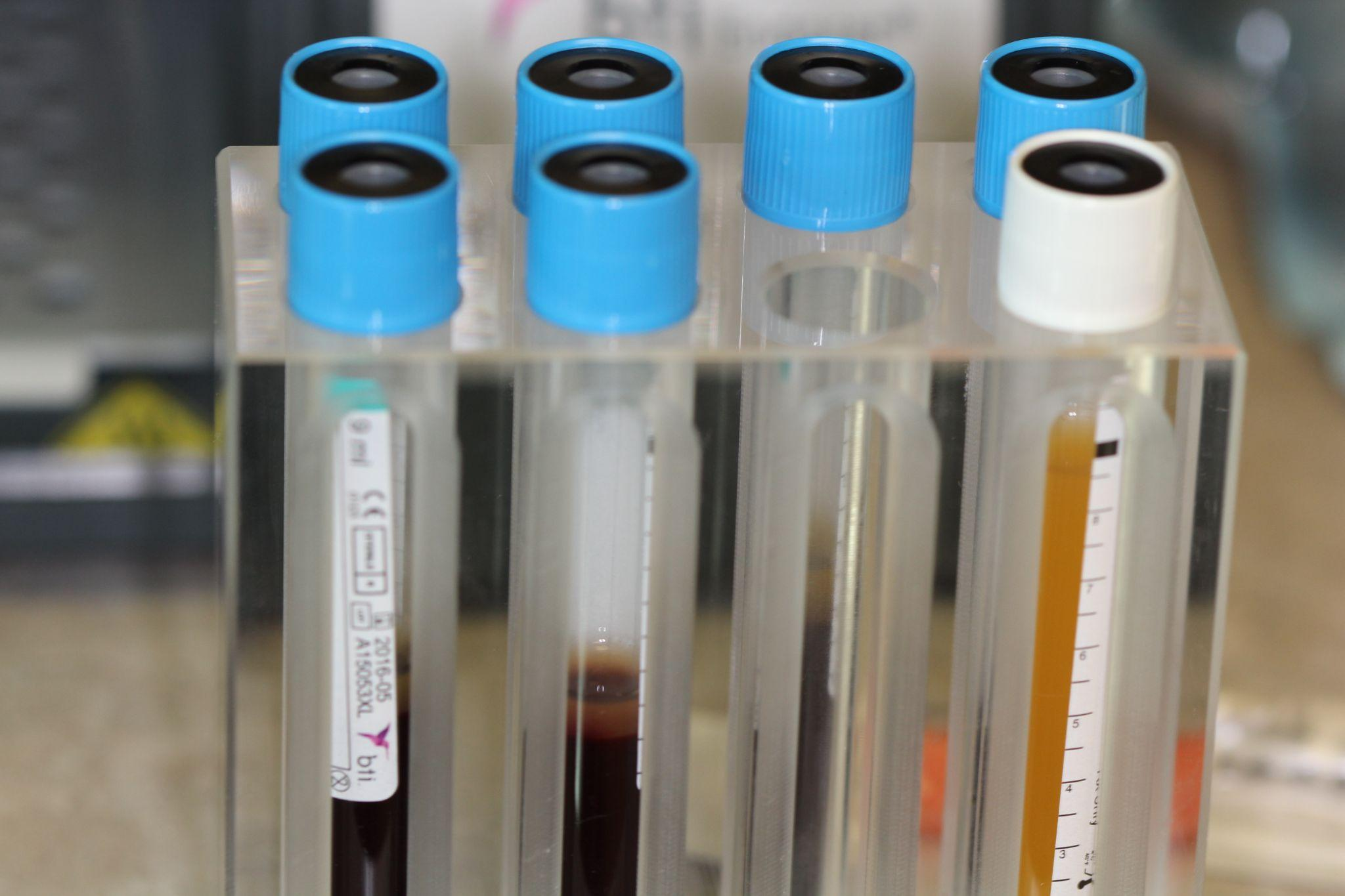 Several test tubes containing fluids lined on a tray