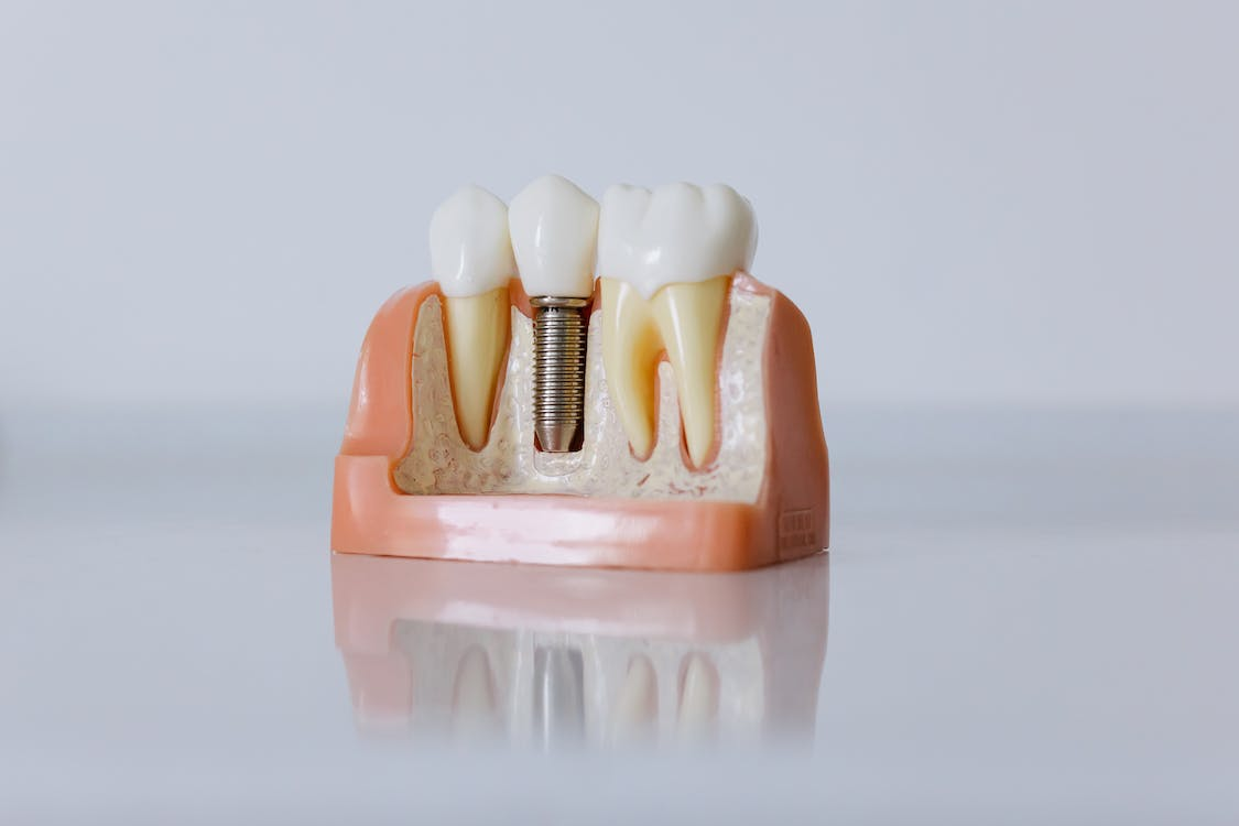 A dental implant model