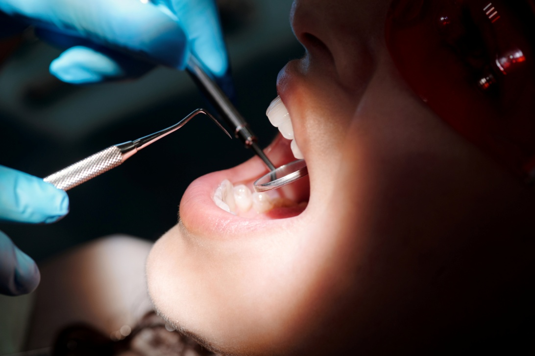 A patient with an open mouth having their teeth inspected