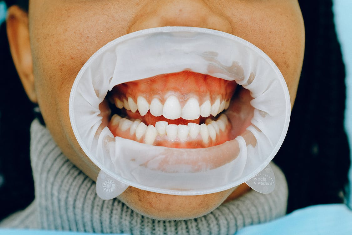 Closeup of a person’s mouth covered with a dental retractor