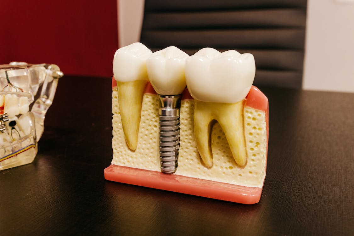 A dental implant model