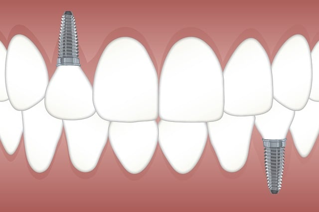 Animated dental implants