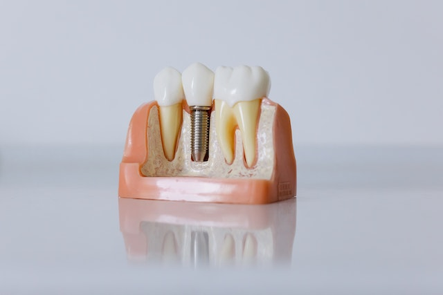 Closeup of top-quality dental implants in Mission Viejo