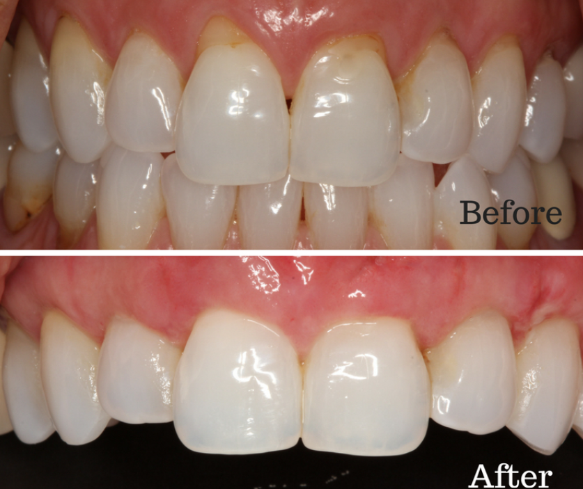Before and after shots for pinhole surgery