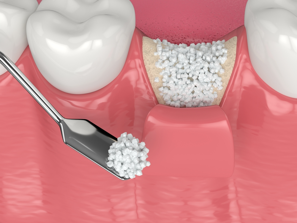dental bone graft procedure